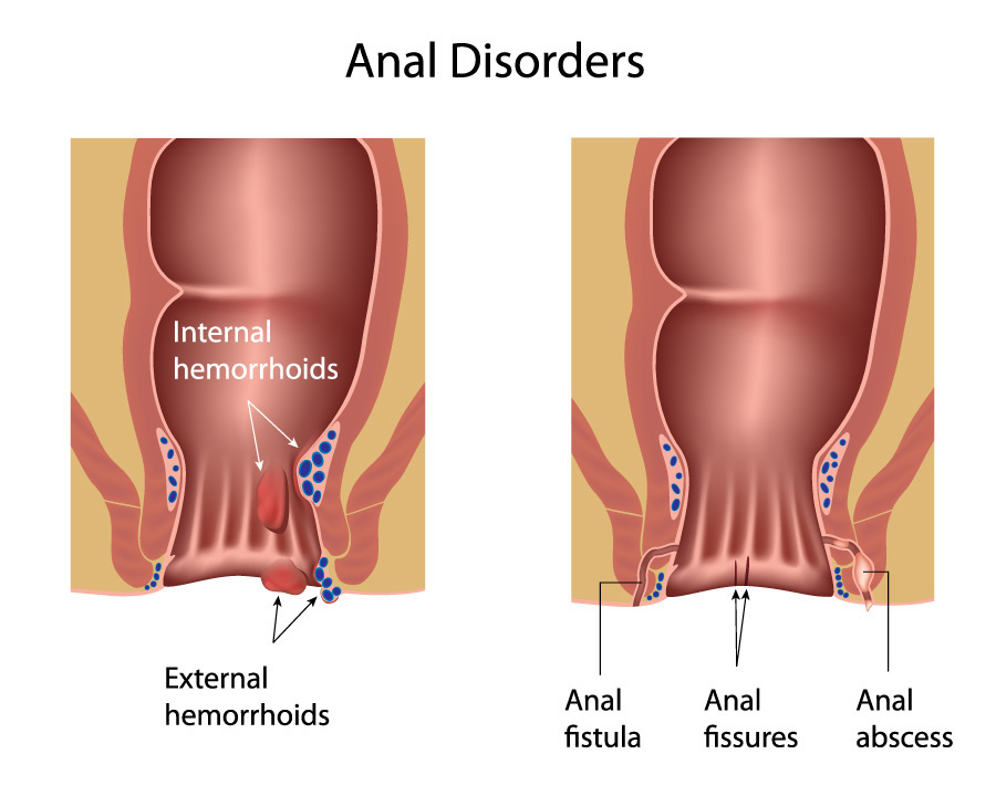 Anal Fissure, Abscess and Fistula Albany Gastroenterology Consultants